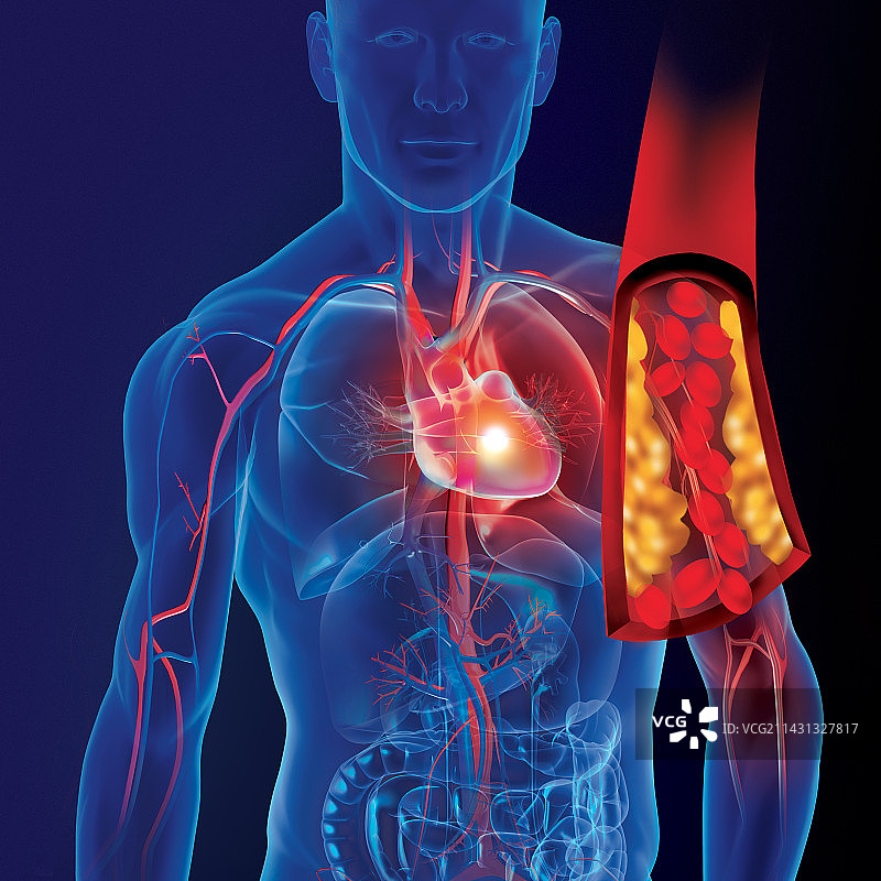 心肌梗死，图示图片素材