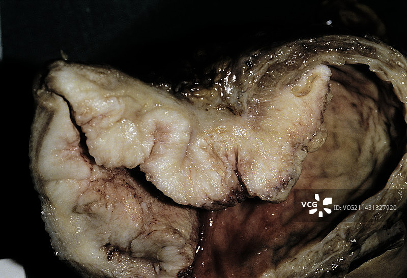 膀胱癌图片素材
