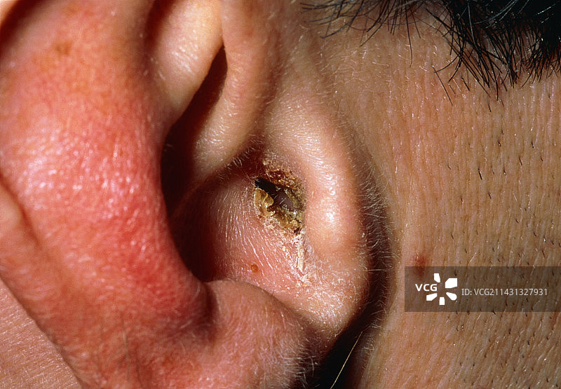男性患者的感染性外耳炎图片素材