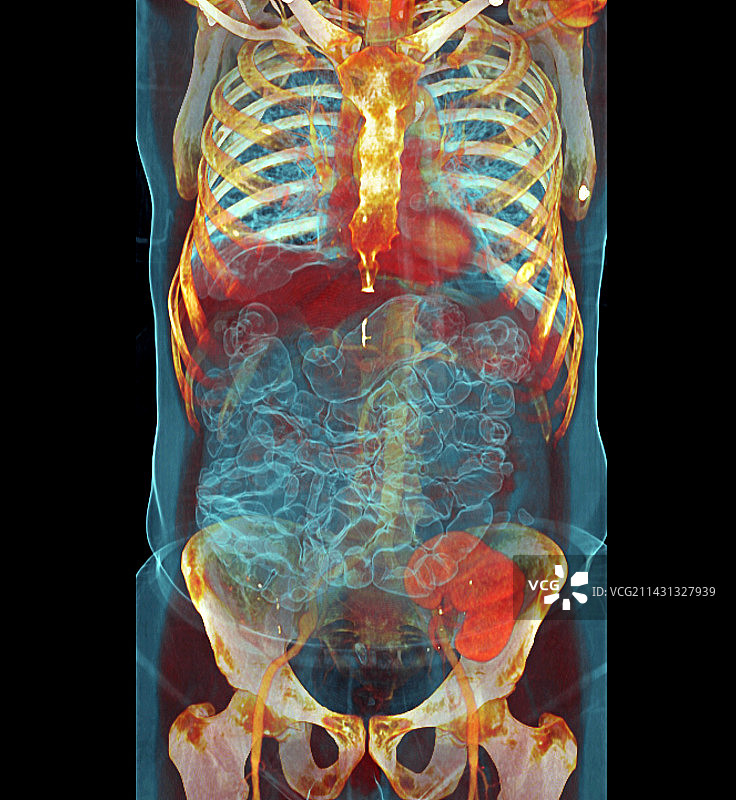 移植肾脏CT扫描图片素材