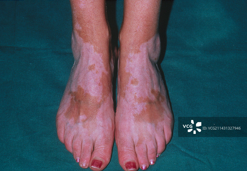 女性脚部的白癜风图片素材