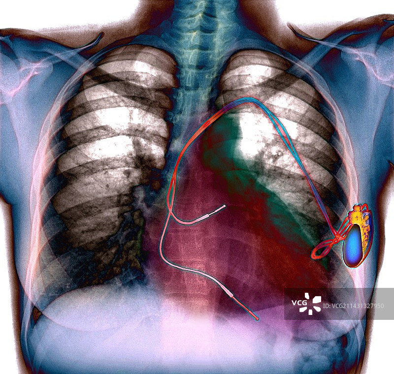 心脏起搏器X光片图片素材
