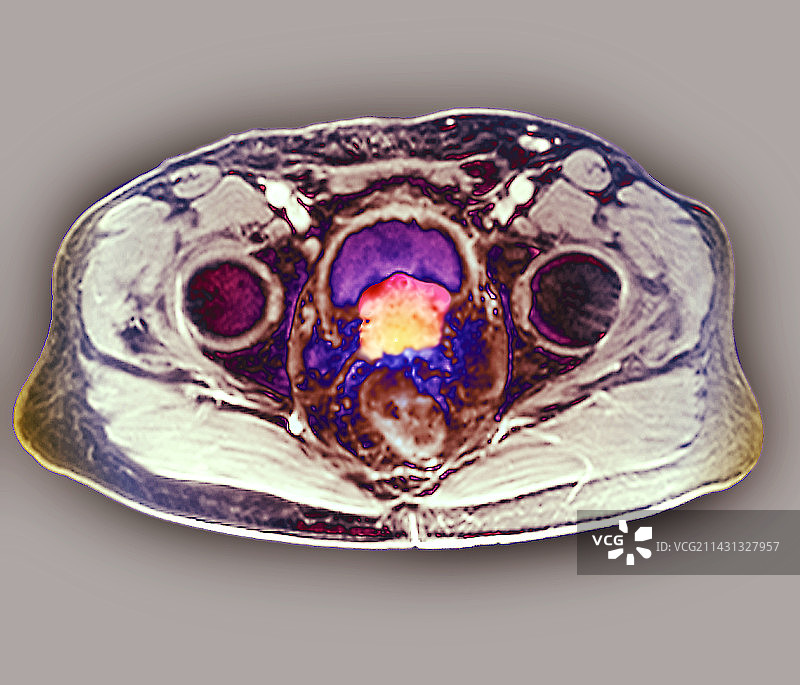 前列腺癌核磁共振扫描图片素材