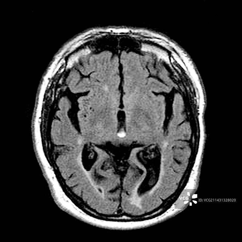 酒精性痴呆，核磁共振扫描图片素材
