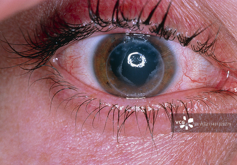 排斥人眼角膜移植图片素材