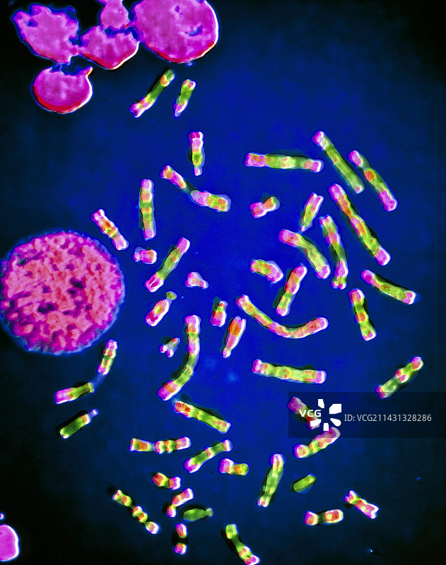 克莱恩费尔特综合征染色体显微照片图片素材