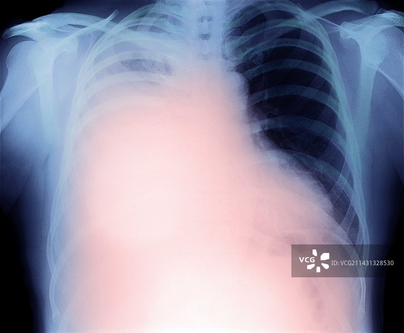 间皮瘤胸腔积液X光片图片素材