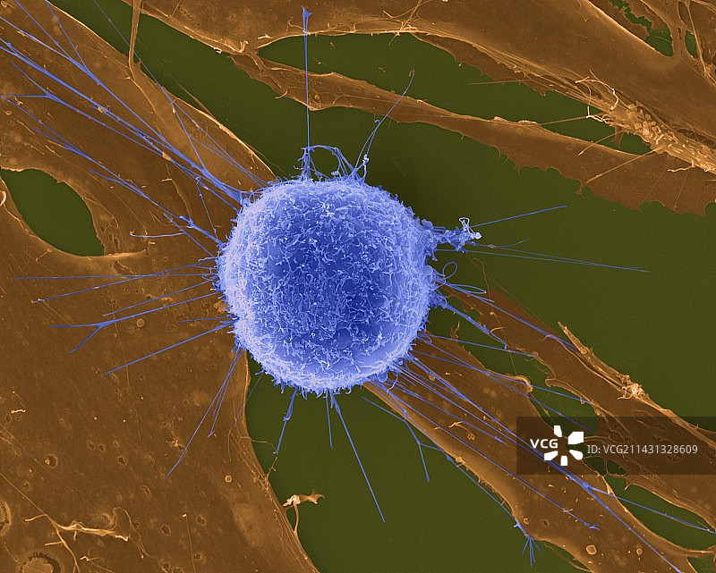 T淋巴细胞攻击肿瘤细胞扫描电镜图图片素材