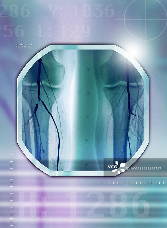 腿动脉狭窄血管造影X光片图片素材