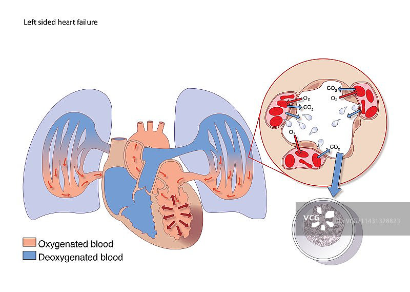 左侧心力衰竭艺术图图片素材