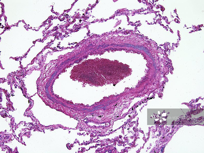 肺动脉高压显微照片图片素材