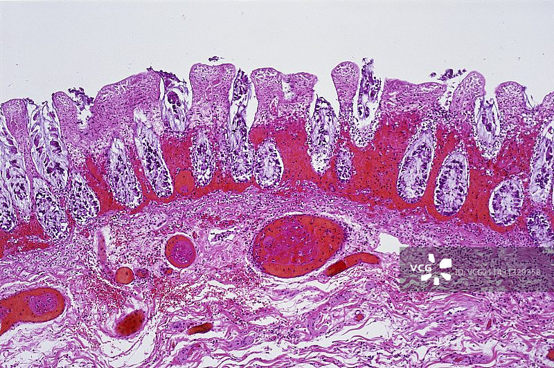 缺血性肠，光镜图片素材