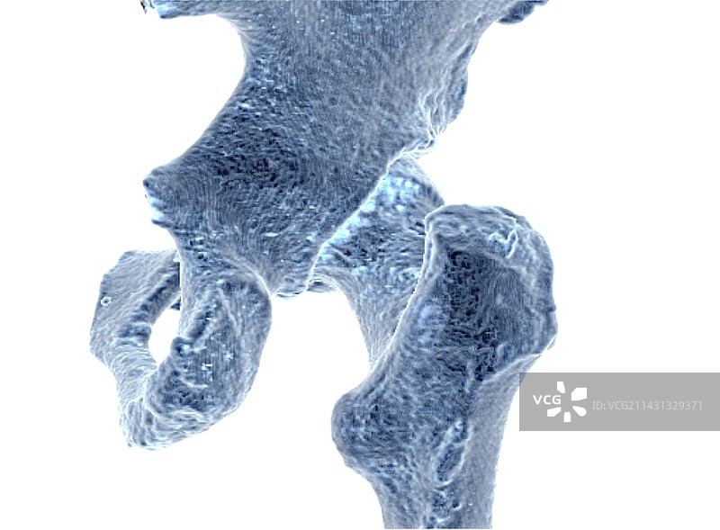 髋部MRI数据的3D骨骼重建图片素材
