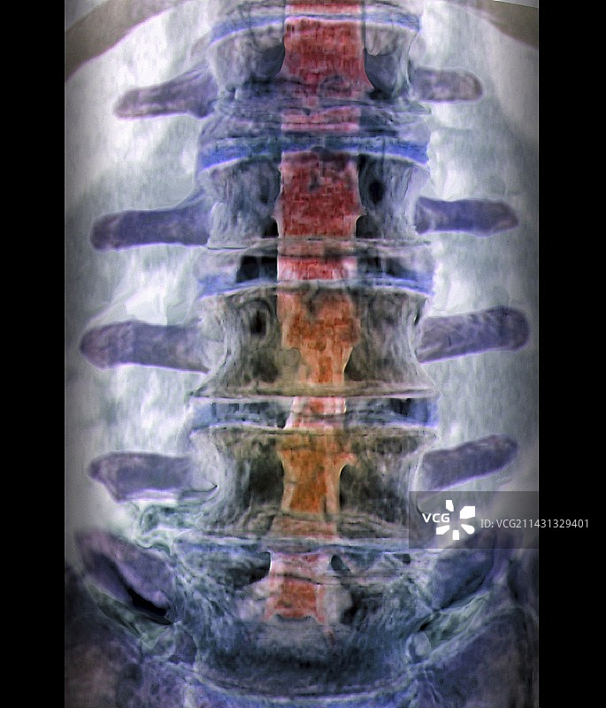 椎间盘突出，三维CT扫描图片素材