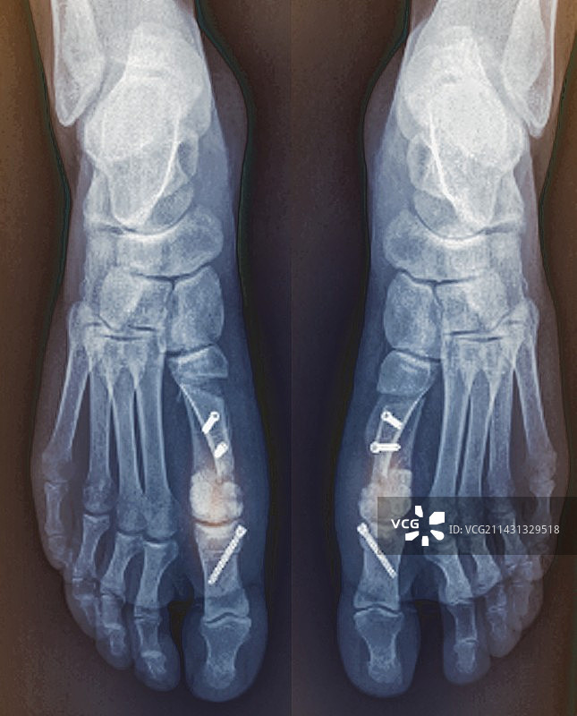 拇外翻手术，足部X光片图片素材