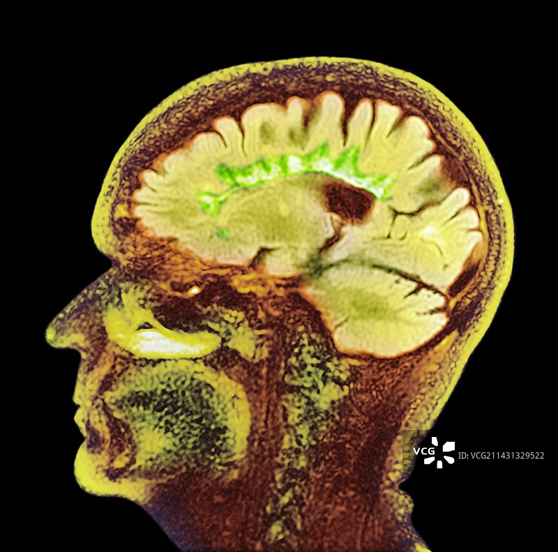 多发性硬化，矢状脑部核磁共振扫描图片素材