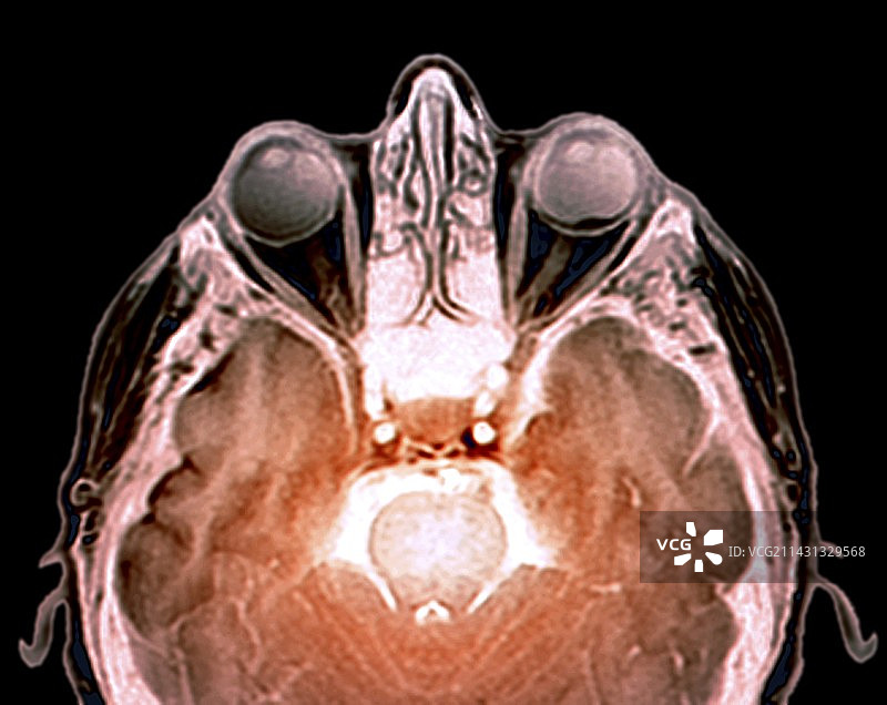 视网膜脱离核磁共振扫描图片素材