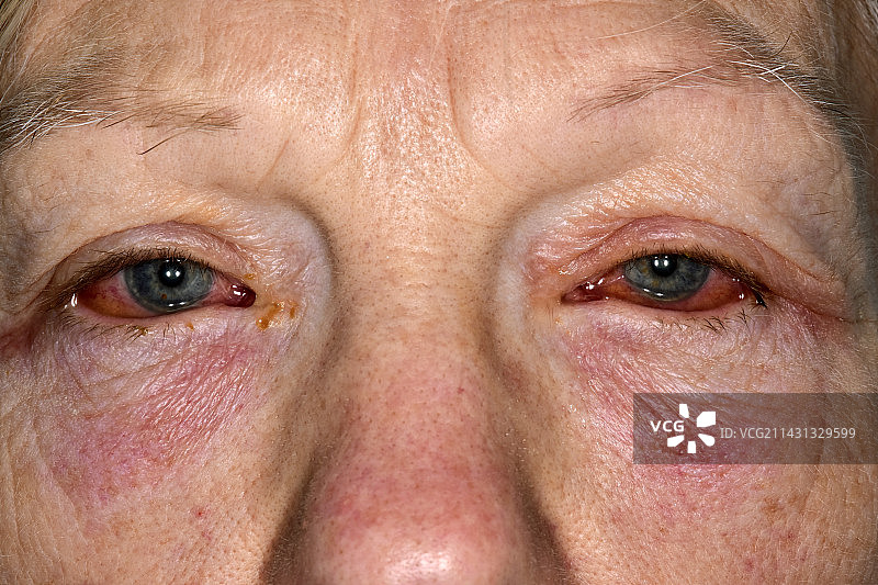 病毒性结膜炎图片素材