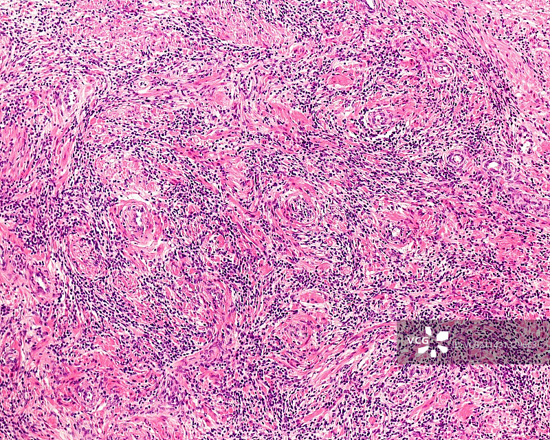 良性前列腺增生，光学显微照片图片素材
