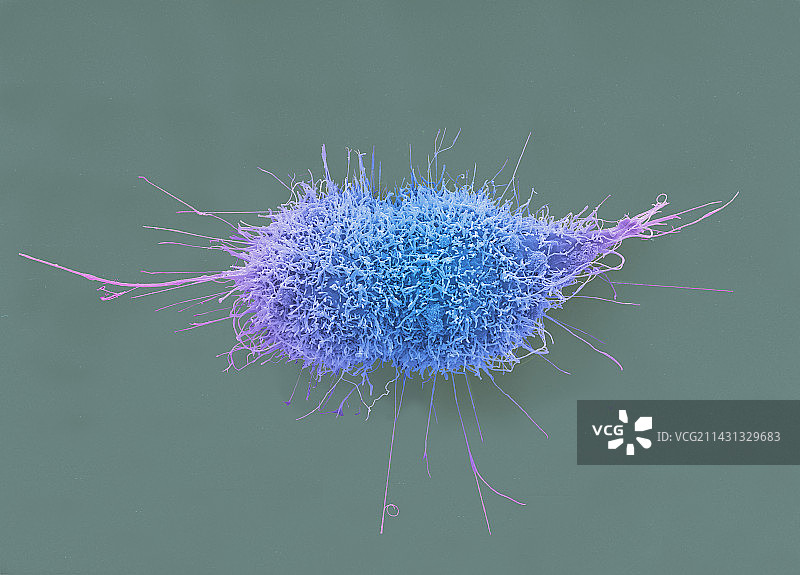 宫颈癌细胞分裂，扫描电镜图片素材