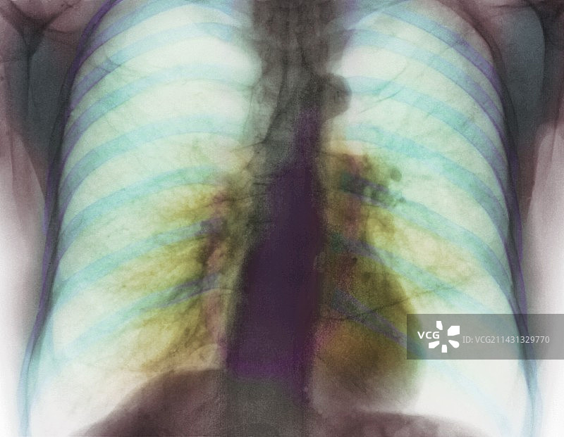 肺气肿X光片图片素材