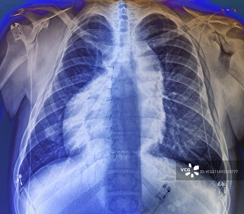 内脏反转X光片图片素材