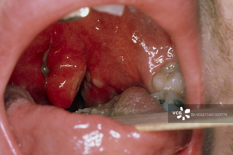 急性扁桃体炎照片图片素材
