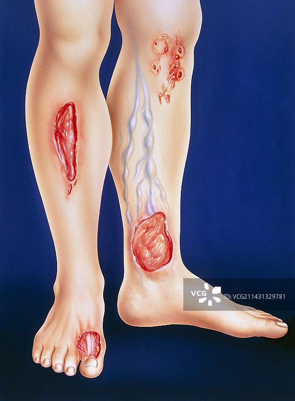 不同类型的腿部溃疡图片素材