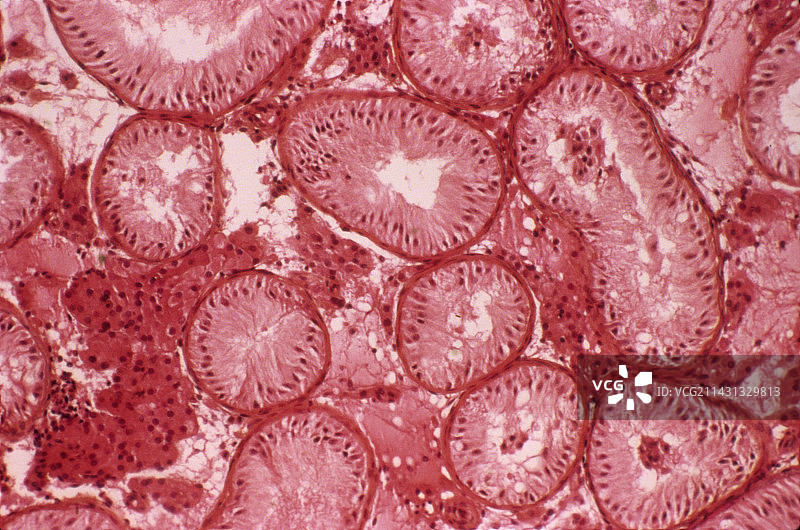 男性不育症，显微照片图片素材