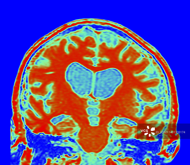 路易体病脑部核磁共振成像图片素材