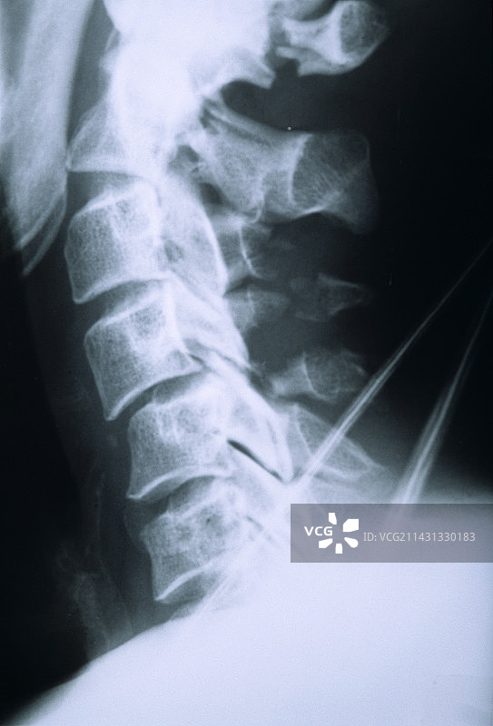 颈部骨折X光片图片素材