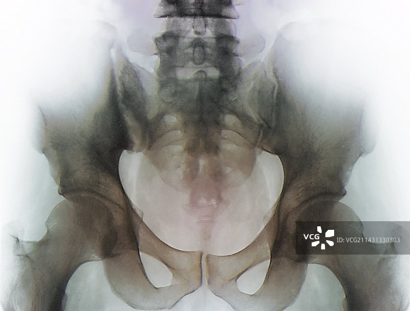 骨盆骨关节炎X光片图片素材