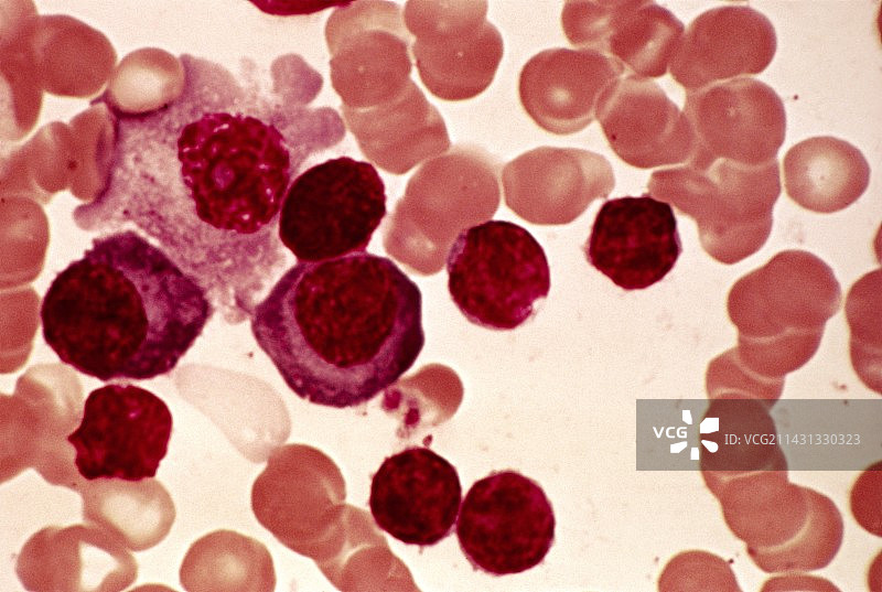 淋巴浆细胞淋巴瘤显微照片图片素材