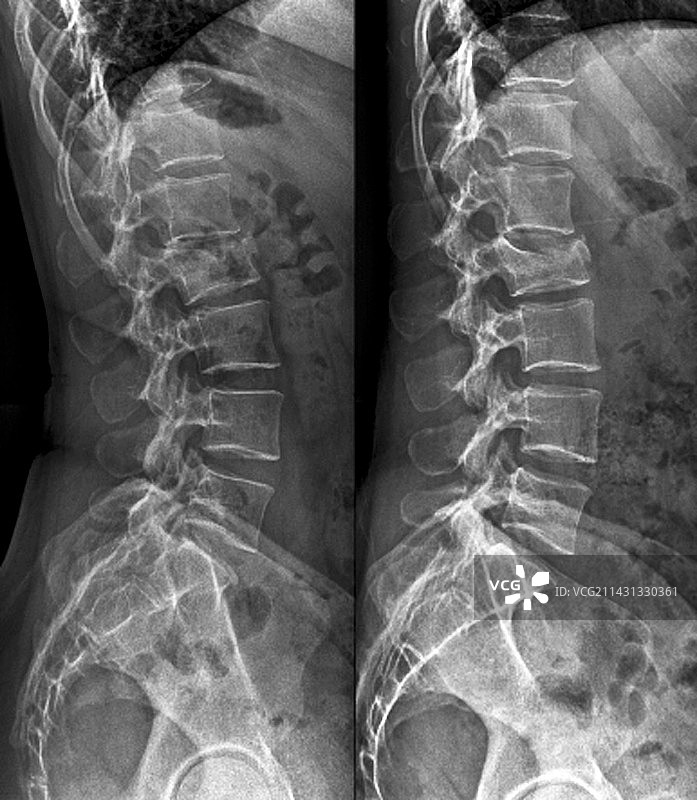 未经处理的椎骨骨折X光片图片素材
