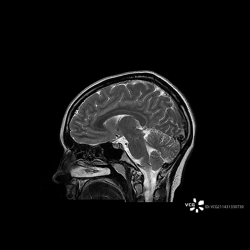 青少年大脑的核磁共振扫描图片素材
