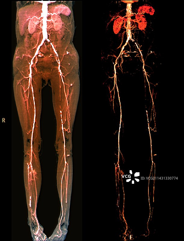 血管疾病CT扫描图片素材