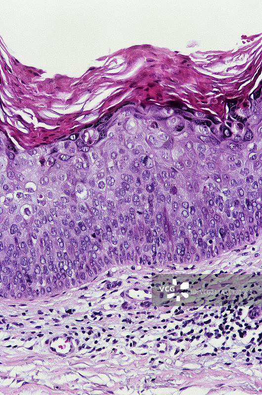 鲍温病图片素材