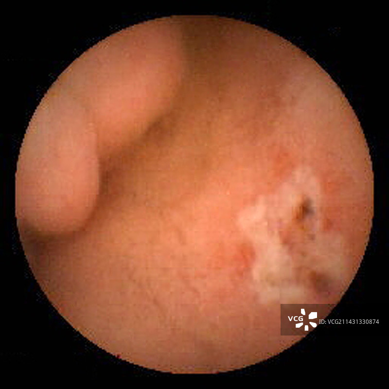 十二指肠溃疡，胶囊内窥镜观察图片素材