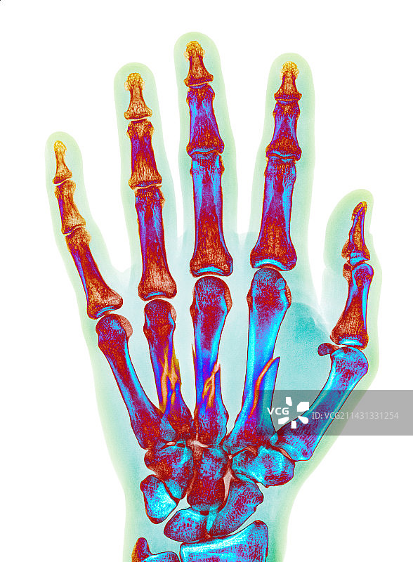 手掌骨骨折X光片图片素材