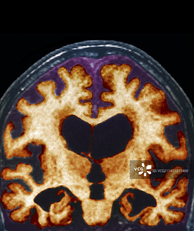 阿尔茨海默症大脑磁共振成像图片素材