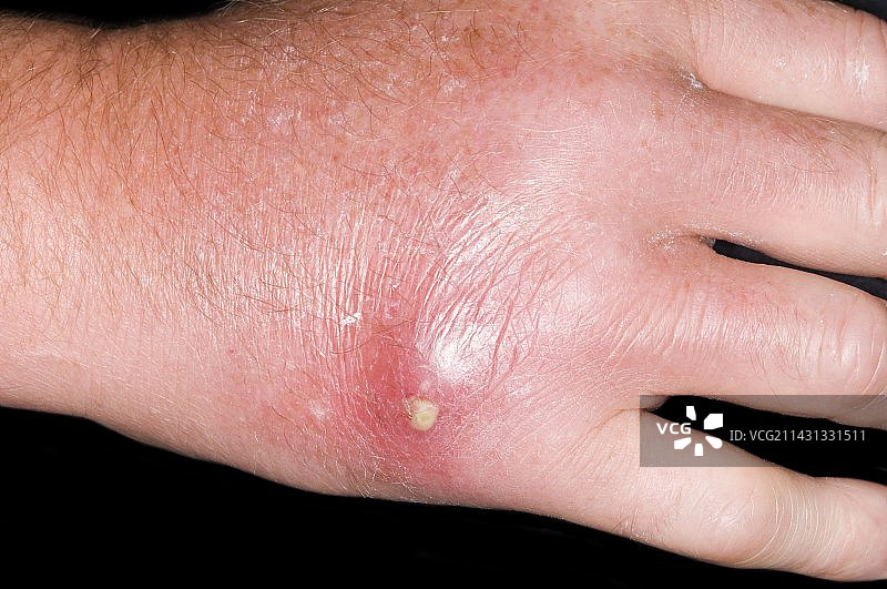 昆虫叮咬后手部脓肿图片素材