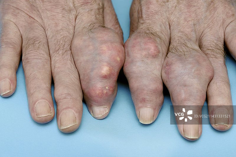 因痛风而肿胀的手指图片素材