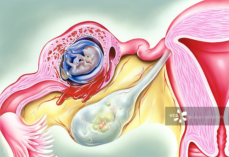 异位妊娠医学插图图片素材
