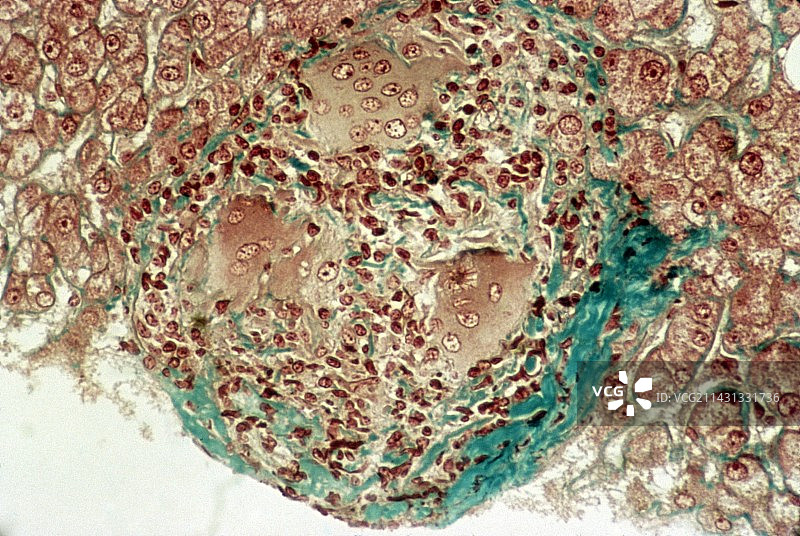 肝脏结节病，光学显微照片图片素材