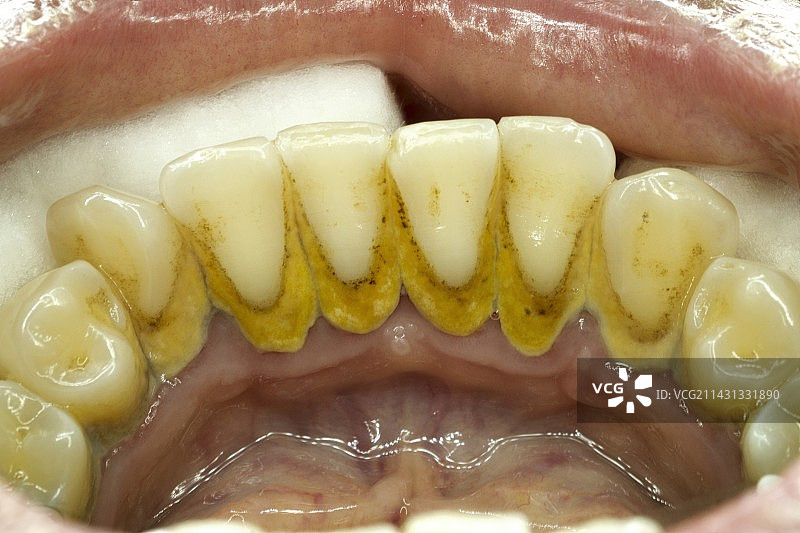 牙齿上的牙菌斑和牙垢图片素材