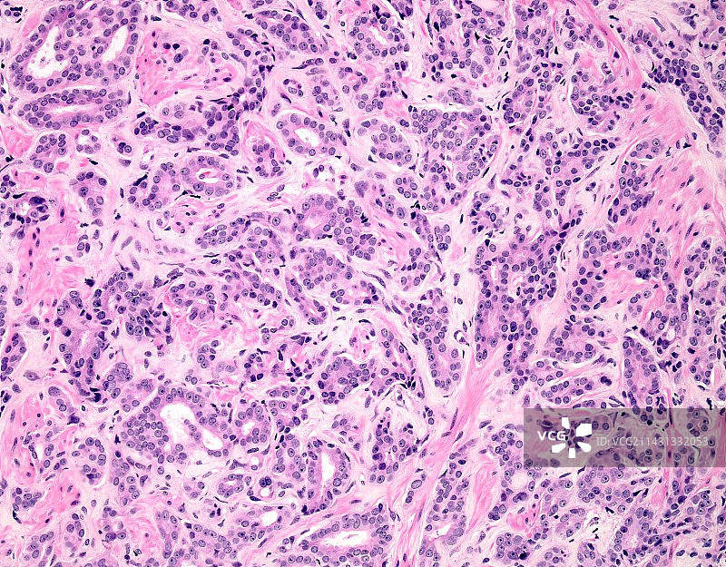 前列腺癌，光学显微照片图片素材