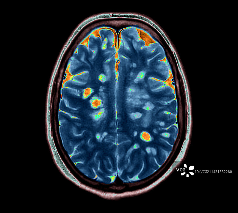 多发性硬化症MRI扫描图片素材
