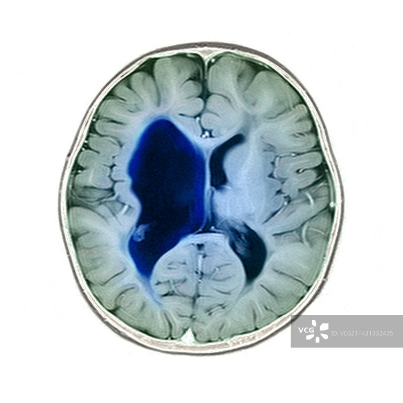 脑瘫，核磁共振扫描图片素材