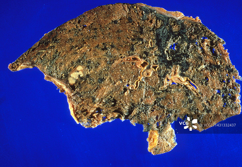 肺癌：切除的焦油染色肺图片素材