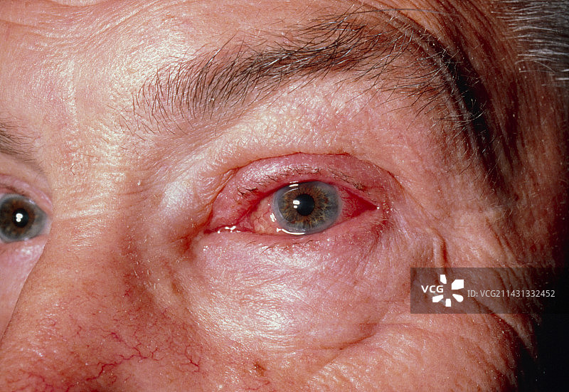 角膜擦伤，眼睛发红图片素材